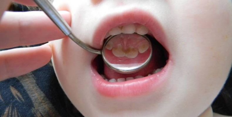 К чему может привести беспечное отношение к своим зубам, рассказал стоматолог Яков Финеев